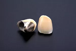 被せ物_プラスティック前装冠